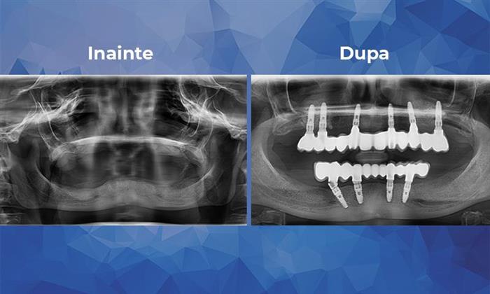 Un caz de reabilitare complexă la maxilar cu sinus lift bilateral şi 6 implanturi, iar la mandibulă cu 4 implanturi cu încărcare imediată
