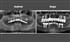 reabilitare orala prin implant cu grefe osoase