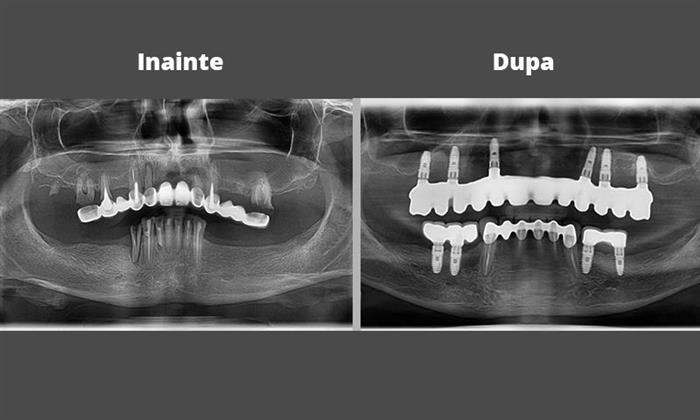 Un caz de reabilitare orala prin implant cu grefe osoase