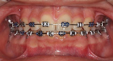 Aparate ortodontice fixe metalice